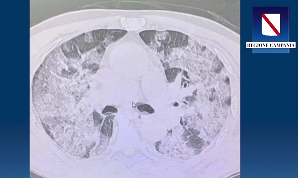 Covid, De Luca descrive una tomografia polmonare per essere più convincente